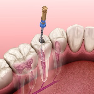 Illustration of a root canal treatment for tooth in lower arch