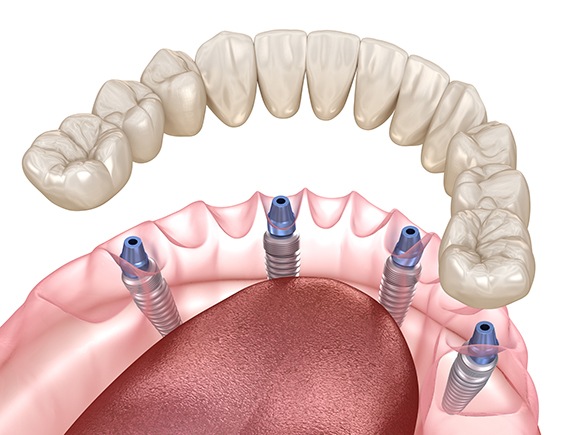 Digital illustration of all-on-4 dental implants