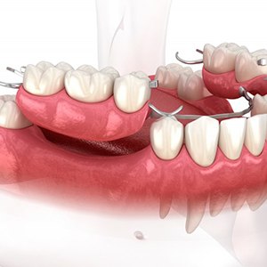 illustration of partial dentures?