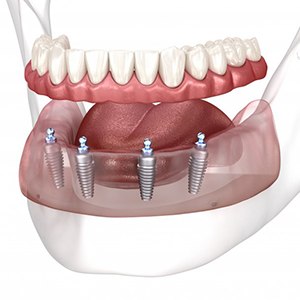 Illustration of implant dentures