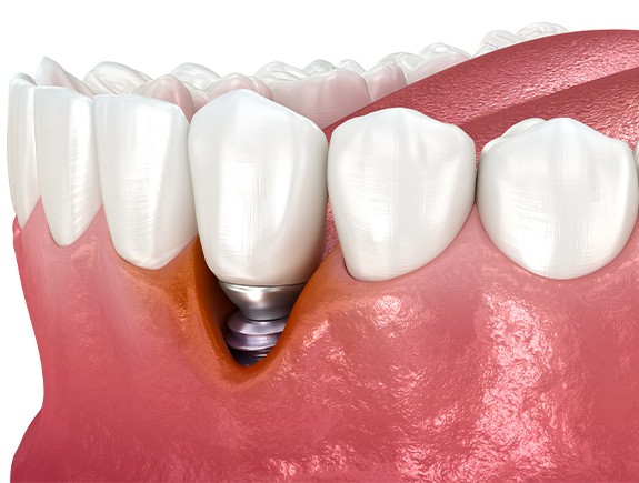 Digital image showing receding gums around a dental implant