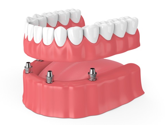 Illustration of implant dentures in West Caldwell, NJ for the lower jaw